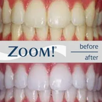 Zoom whitening example